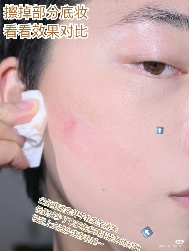 4种「痘痘遮瑕大法」