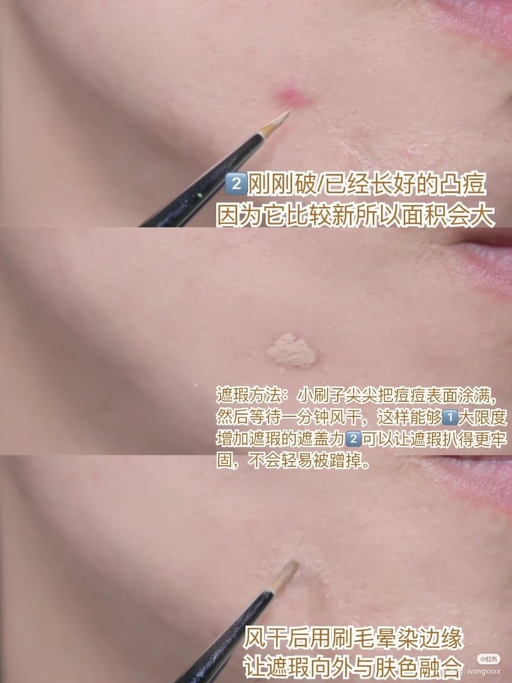 2、刚刚破、已经长好的凸痘