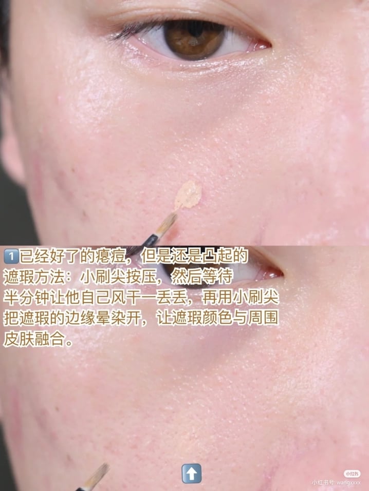1、已经好了的瘪痘