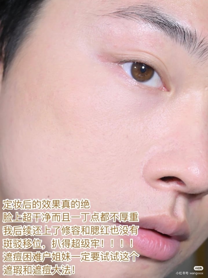 4种「痘痘遮瑕大法」