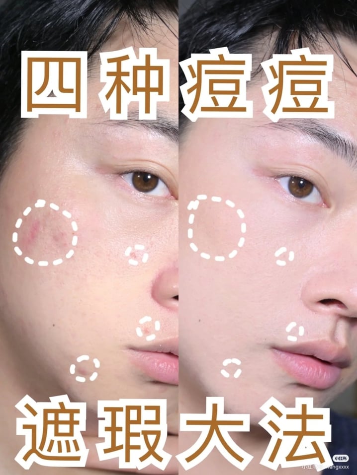 4种「痘痘遮瑕大法」