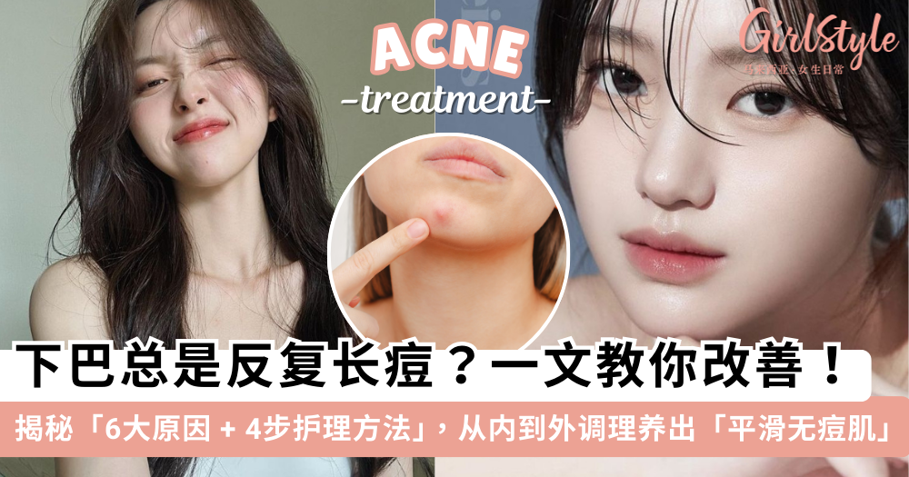 下巴反复长痘?6大原因揭秘 + 4步护理方法,让痘痘不再复发!
