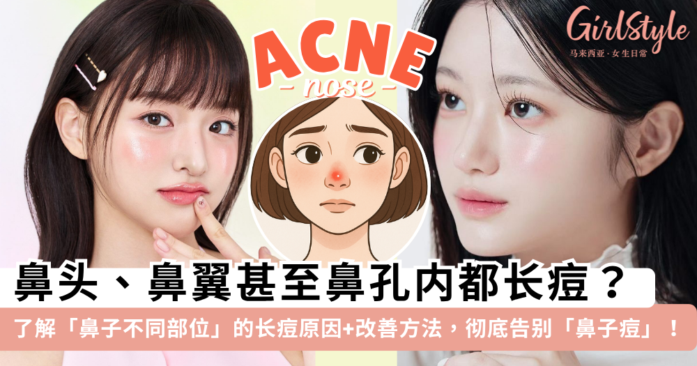 鼻子长痘痘代表什么?一文了解鼻子不同部位长痘的原因+改善方法