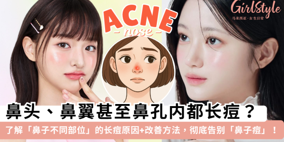 鼻子长痘痘代表什么？一文了解鼻子不同部位长痘的原因+改善方法